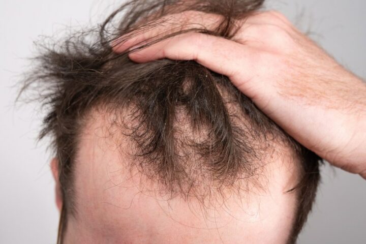 Could soon be found a treatment for hair loss? Balding causes discovered by researchers
